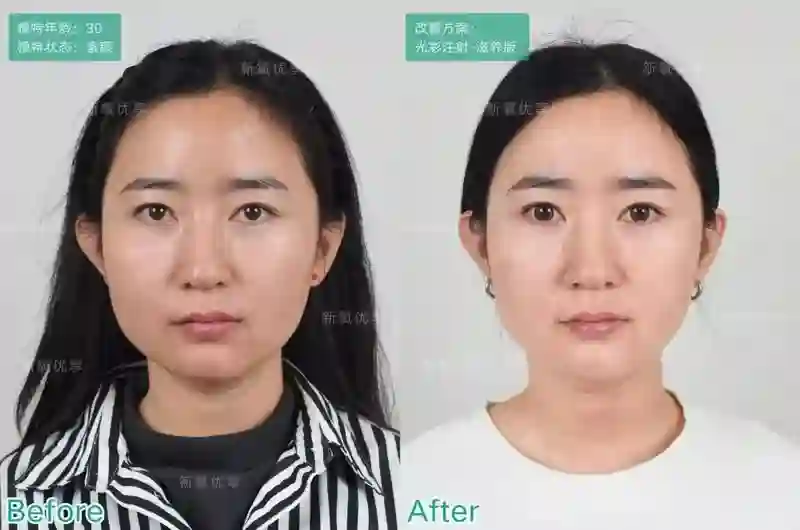 表面陪谢霆锋度假，实则去日本打50万一支水光针？王菲真是林允唯一的姐…