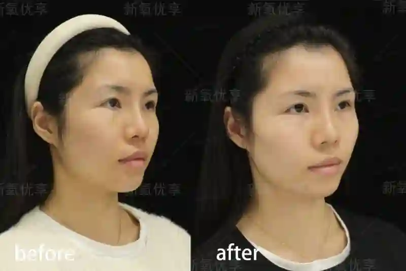 表面陪谢霆锋度假，实则去日本打50万一支水光针？王菲真是林允唯一的姐…