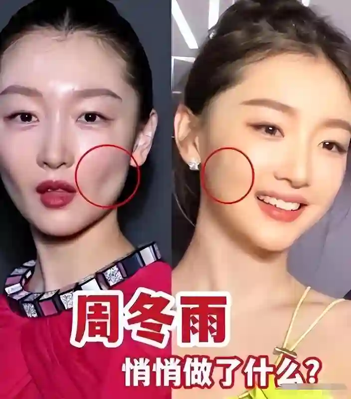 医美做得也太夸张了！以前极具辨识度的周冬雨，如今变成这样了