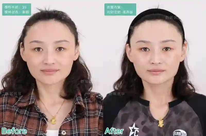 表面陪谢霆锋度假，实则去日本打50万一支水光针？王菲真是林允唯一的姐…