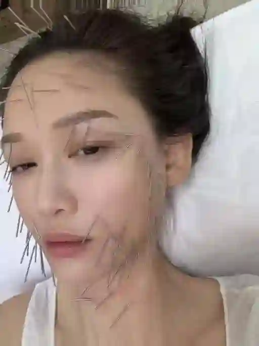 46岁陈乔恩针雕后现身！脸上满满胶原蛋白，令人惊叹效果显著